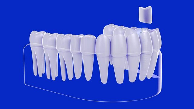 3D animation of a dental implant in a white and transparent graphic style. Showing the implant separated before placement. Placed in the glass gum on a blue background, showing the anatomical interior