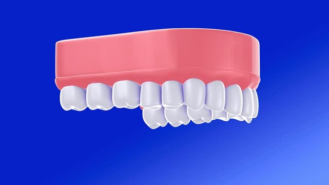3D illustration of a dental prosthesis in a realistic graphic style. Before and after placement in a gum with dental implants to hold it, which rotates. On a blue background, viewed from below.

