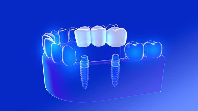 3D animation of a dental implant being placed in a denture. It is placed in a transparent glass gum, on top of an anatomical human head. The interior is shown on a blue background.