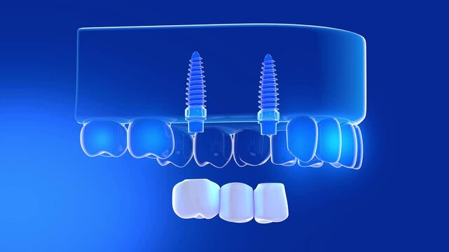 3D animation of a denture with a rotating transparent glass gum. Showing the anatomical interior with lights on a blue background.