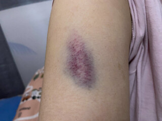 A close-up shot captures a dark purple bruise on a person's upper arm