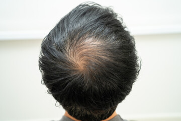 Bald in the middle head and begin no loss hair glabrous of mature Asian business smart active...