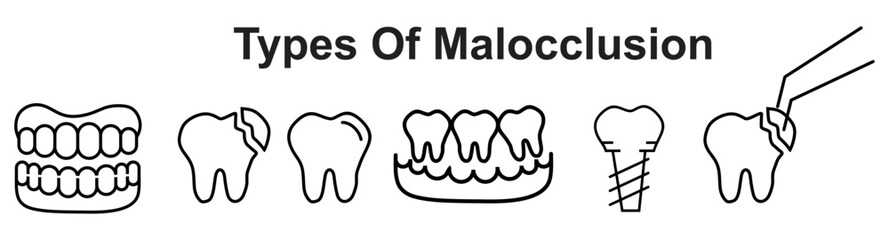 types of malocclusion, including spacing, overcrowding, crossbite, overbite, underbite, and open bite diagram hand drawn schematic raster illustration. Medical science educational illustration 