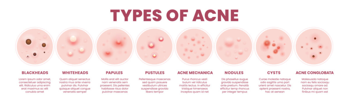 Body skin acne type pore inflammation infographics. Blackheads, whiteheads, papule, pustule, cyst and nodules, acne mechanica or acne conglobata. Skin disease caused by excess oil production, bacteria