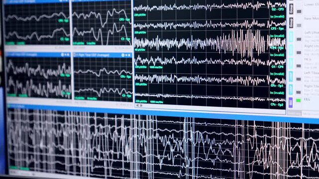 Diverse curved lines running on the monitor pf computer. Screen of equipment displays brain waves during neurosurgery. Close up.