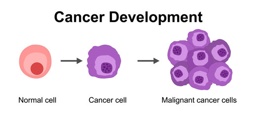 Cancer development. Normal cells are transformed into cancer. Carcinogenesis from Genetic mutations in healthy cell to Malignant cancer cells. Mutagenesis, Oncogenesis, tumorigenesis. Tumor formation