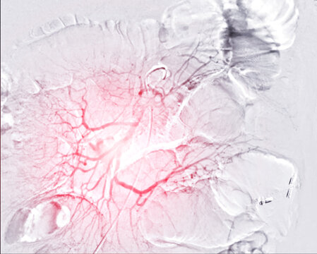 The angiographic view of the hepatic artery during embolization. The highlighted red vessels demonstrate targeted blood flow control, aiding in the treatment of liver-related conditions.