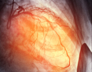Cardiac Catheterization is a medical procedure used to examine the heart's blood vessels.