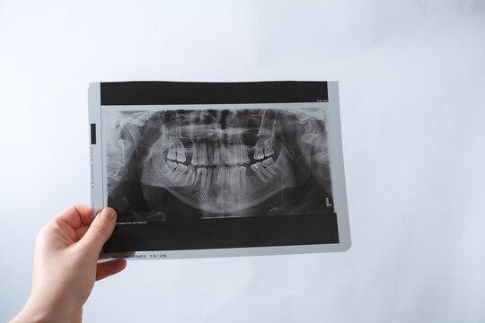 Dental X-ray diagnostics help identify hidden tooth problems and ensure accurate treatment planning.