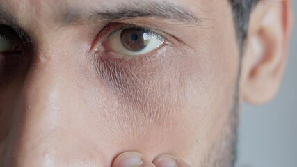 Indian young man showing his periorbital dark circles.