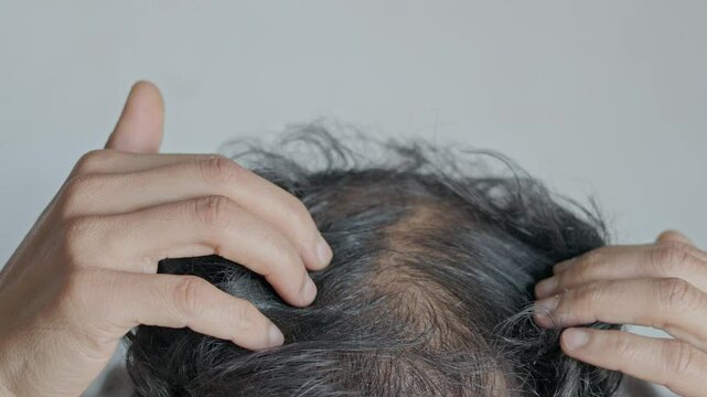 Man showing his visible hair loss scalp, male pattern baldness, androgenic alopecia.