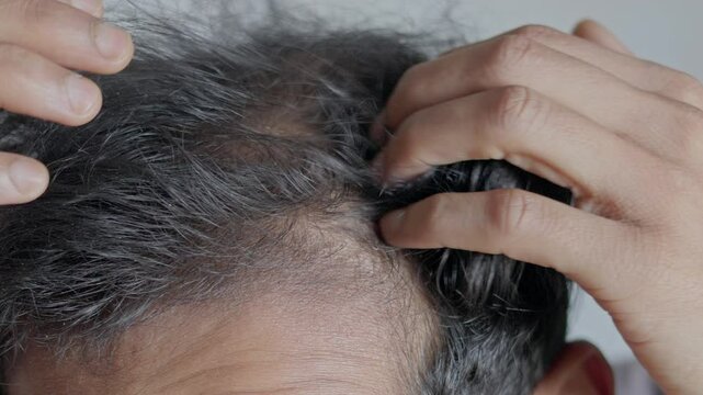 Hair loss, male pattern baldness, androgenic alopecia, hair thinning, dandruff. Man touching his bald patches.