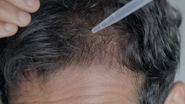 Male person with a dropper applying essential oil for hair loss, minoxidil for androgenic alopecia treatment.