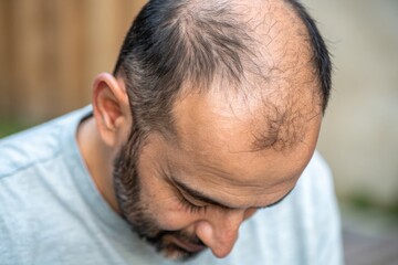 Obraz premium Man With Thinning Hair Looking Down Outdoors in Casual Setting Generative AI