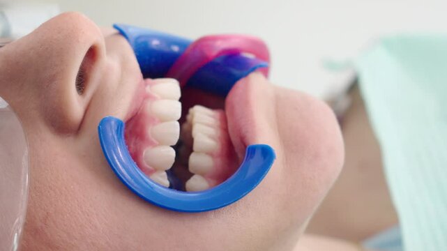 Cosmetic teeth whitening treatment in progress at professional dental office