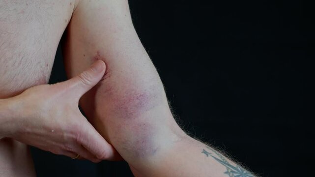 Detailed closeup of a bruised biceps and shoulder with tendon damage. Deep discoloration from internal bleeding as hand gently examines the affected area