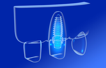 3D illustration of a dental implant with a screw in a transparent graphic style. With interior light. Placed on a glass gum on a blue background, showing the inside.