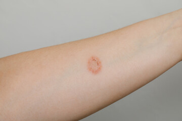 Contact Dermatitis or infection symptom on human skin