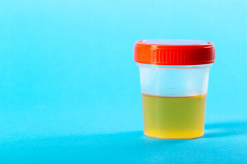 Medical container with urine test on a blue background. Concept urine test for pyelonephritis and...