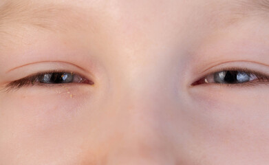 Fototapeta premium The girl has swollen, reddened, painful eyes. Inflammation of conjunctivitis, pus in the eyes. Bacterial infection, close-up