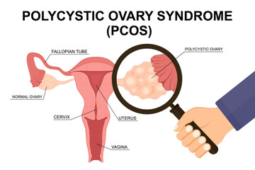 Cross-Section of Female Reproductive System with Polycystic Ovary Syndrome (PCOS). Polycystic ovary and Healthy Ovary. Uterus internal view. 
