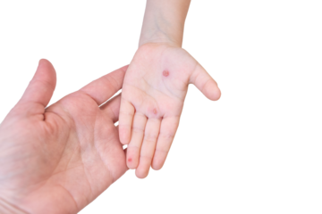 Mother examining child's hands with chickenpox wounds on gray background. Child health care concept