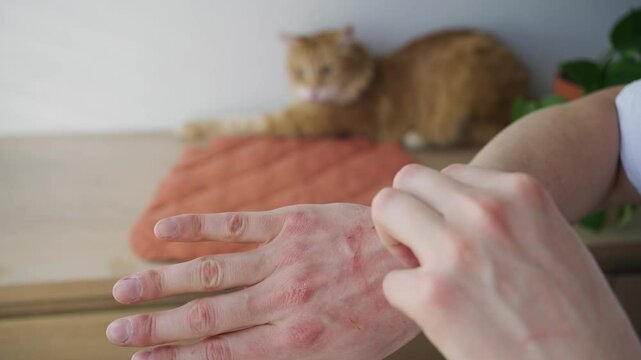Redness and itching on male hand, man applying moisturizing ointment for allergy or eczema, domestic ginger cat watching, skin problem, treatment and care