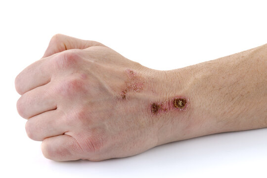 Scratch or scrape or abrasion wounds on the back of a hand, damaged skin on white background