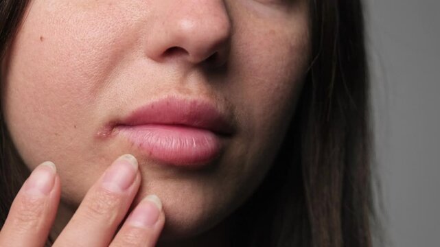 Close-up of a woman's lips with a visible cold sore touching her face, showing skin texture and natural imperfections. Female lip ulcers herpes.