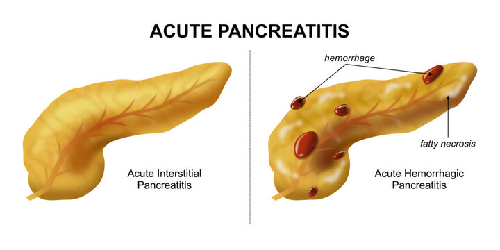 Acute Pancreatitis Hemorrhagic, fatty necrosis pancreas illustration