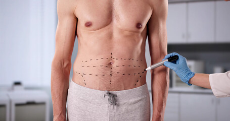 Transformative Tummy Tuck Procedure Enhances Man's Aesthetic