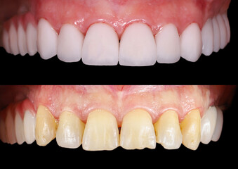 emax ceramic veneers