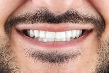 emax ceramic veneers