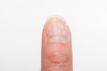 Close-up of a damaged fingernail with peeling and brittle surface on a white background. Concept of nail health, injury, and care. Mechanical nail damage. bad habits. nail health on hormonal balance