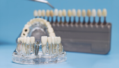 transparent dental implant model with a shade guide in the background, used for tooth color...