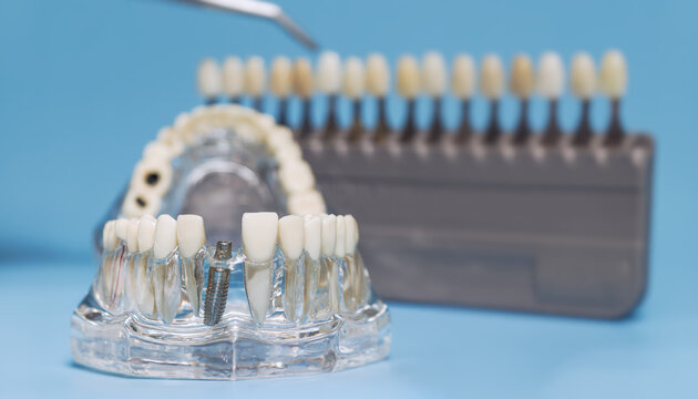 transparent dental implant model with a shade guide in the background, used for tooth color matching in restorative dentistry.