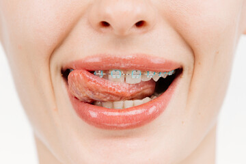 A close-up of a woman's teeth with full lips and braces. She smiles, showcasing her commitment to oral hygiene and confidence in her smile.