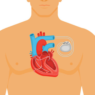 Pacemaker, cardiac pacemaker medical illustration