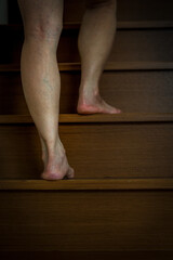 Asian women Varicose vein on leg