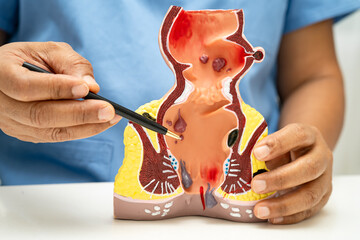 Asian doctor with rectum and hemorrhoid human anatomy model at hospital, inflamed vascular...