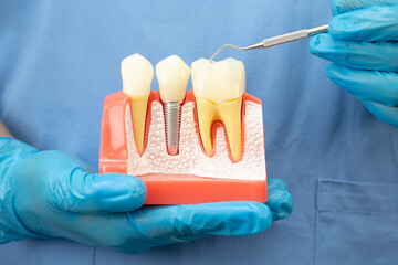 Asian dentist holding dental implant, artificial tooth roots into jaw, root canal of dental treatment, gum disease, teeth model for dentist.