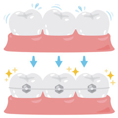 歯並びが乱れた歯と矯正された歯のイラストセット