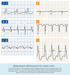 When measuring the cardiac cycle, select leads with stable ECG waveform and choose ECG waves from the same location as the measurement reference point.
