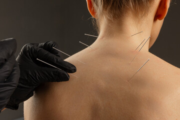 Close up of dry needling acupuncture procedure on patient's back performed by professional in black...