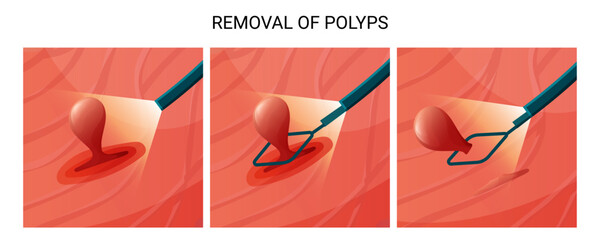 Internal organ polyp removal. Vector medical infographic for endoscopic removal of pollips.