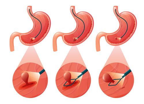 Stomach polyp removal procedure, medical illustration of endoscopic treatment for gastric polyps.