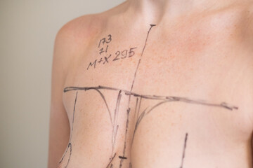 Plastic surgeon marking womans breast with pen before surgery, patient standing topless while doctor draws incision lines on chest, medical aesthetic procedure, medical mammoplasty, mastopexy 