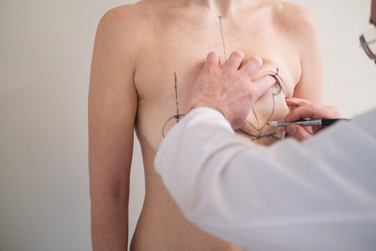 Plastic surgeon marking womans breast with pen before surgery, patient standing topless while doctor draws incision lines on chest, medical aesthetic procedure, medical mammoplasty, mastopexy 