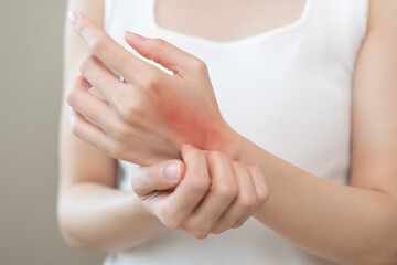 Dermatology asian young woman allergy, allergic reaction from atopic, insect bite, scratching itchy back of hand, red spot or rash of skin. Healthcare treatment of beauty. Isolated on white background
