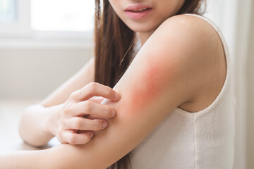 Dermatology asian young woman, girl allergy, allergic reaction from atopic, insect bites on arm,...